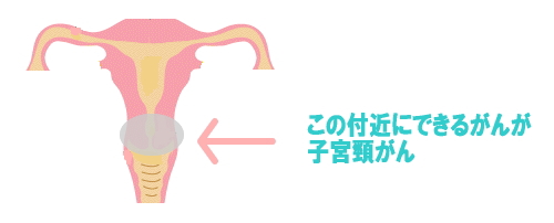 子宮頸がんの位置